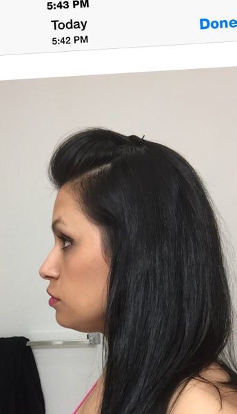 Quá trình tiêm Kybella điêu khắc vùng hàm và loại bỏ túi mỡ thừa lỏng lẻo dưới cằm