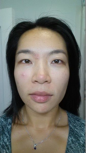 Khuôn mặt thon gọn, đường viền hàm rõ nét sau 3 lần làm Ultherapy