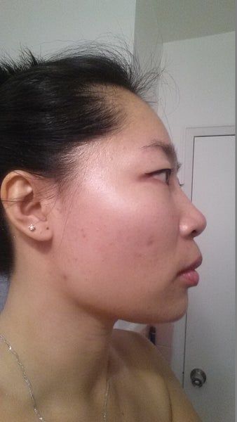 Khuôn mặt thon gọn, đường viền hàm rõ nét sau 3 lần làm Ultherapy