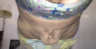 Hành trình loại bỏ khối da thừa nhăn nheo, chảy xệ sau khi giảm kỷ lục 52 kg của mẹ trẻ 2 con