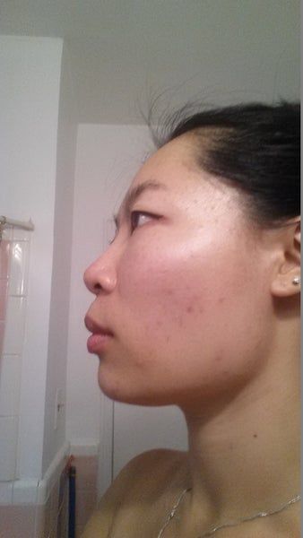 Khuôn mặt thon gọn, đường viền hàm rõ nét sau 3 lần làm Ultherapy