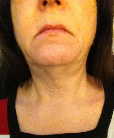 Người phụ nữ 58 tuổi với kết quả điều trị Ultherapy ngoài mong đợi