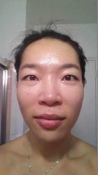 Khuôn mặt thon gọn, đường viền hàm rõ nét sau 3 lần làm Ultherapy