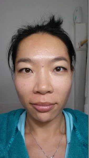 Khuôn mặt thon gọn, đường viền hàm rõ nét sau 3 lần làm Ultherapy