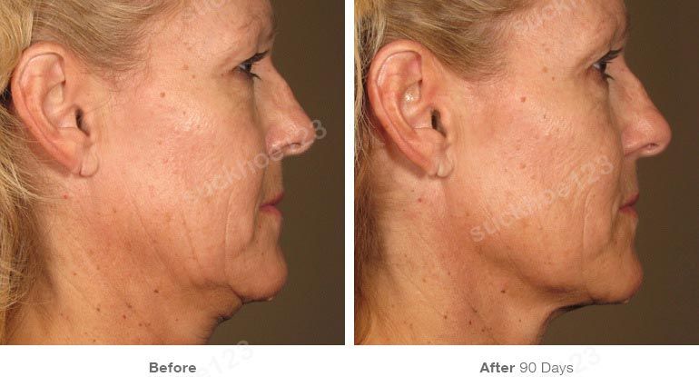 ultherapy truoc sau vung mat 2 suckhoe123
