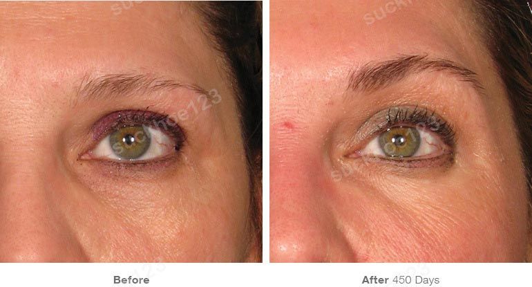 ultherapy truoc sau vung mat 4 suckhoe123