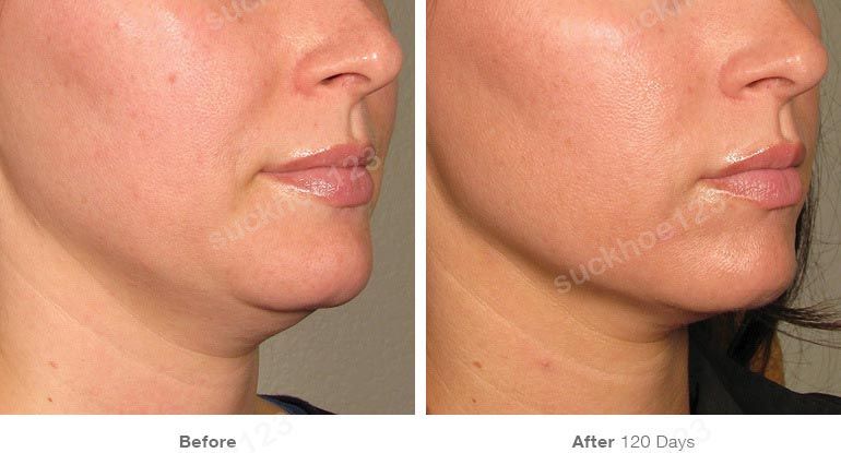 ultherapy truoc sau vung mat 5 suckhoe123
