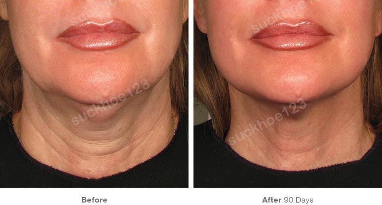 ultherapy truoc sau vung mat 7 suckhoe123
