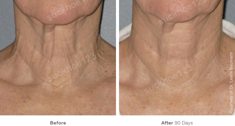 ultherapy truoc sau vung mat 8 suckhoe123