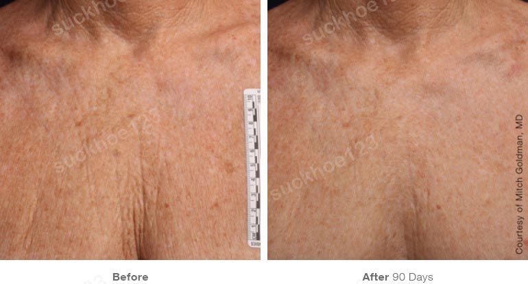 ultherapy truoc sau vung mat 9 suckhoe123