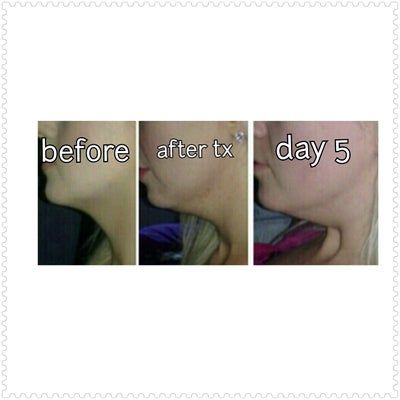 Tiêm Kybella xóa nọng cằm di truyền ở cô gái 27 tuổi