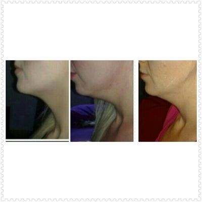 Tiêm Kybella xóa nọng cằm di truyền ở cô gái 27 tuổi