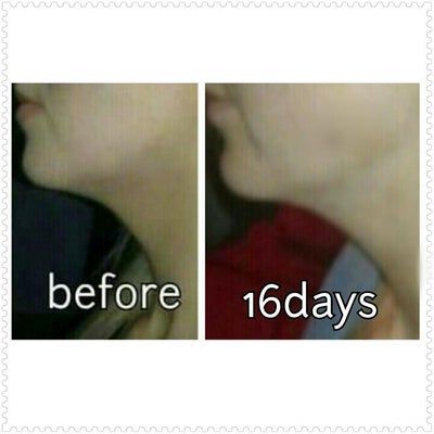 Tiêm Kybella xóa nọng cằm di truyền ở cô gái 27 tuổi