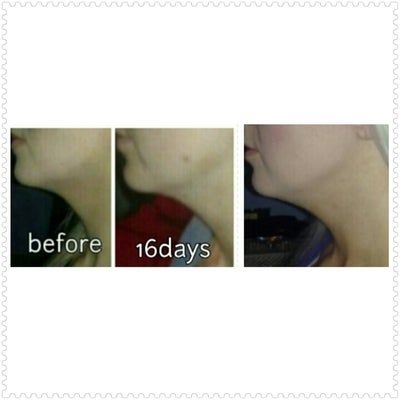 Tiêm Kybella xóa nọng cằm di truyền ở cô gái 27 tuổi