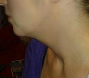 Tiêm Kybella xóa nọng cằm di truyền ở cô gái 27 tuổi