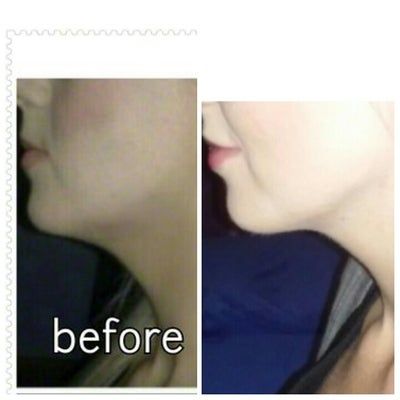 Tiêm Kybella xóa nọng cằm di truyền ở cô gái 27 tuổi