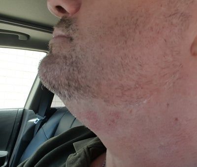 Quý ông 56 tuổi cằm ngấn mỡ, cổ không rõ đường nét với hành trình tiêm Kybella