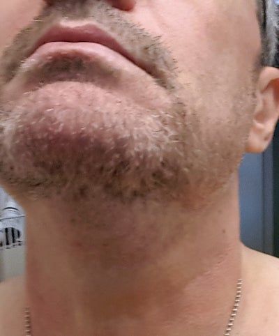 Quý ông 56 tuổi cằm ngấn mỡ, cổ không rõ đường nét với hành trình tiêm Kybella