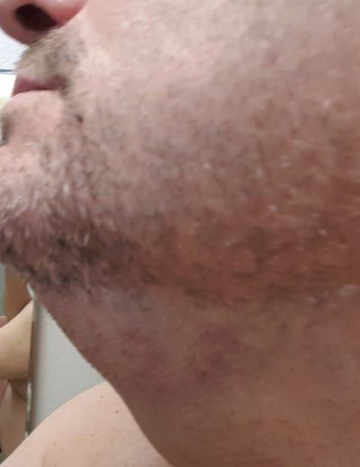Quý ông 56 tuổi cằm ngấn mỡ, cổ không rõ đường nét với hành trình tiêm Kybella