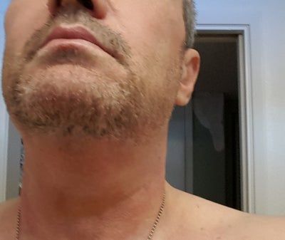 Quý ông 56 tuổi cằm ngấn mỡ, cổ không rõ đường nét với hành trình tiêm Kybella