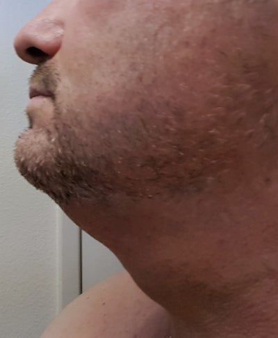 Quý ông 56 tuổi cằm ngấn mỡ, cổ không rõ đường nét với hành trình tiêm Kybella
