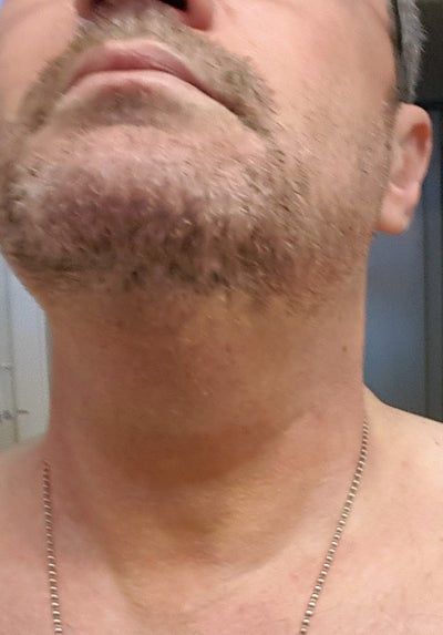 Quý ông 56 tuổi cằm ngấn mỡ, cổ không rõ đường nét với hành trình tiêm Kybella