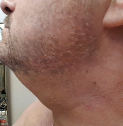 Quý ông 56 tuổi cằm ngấn mỡ, cổ không rõ đường nét với hành trình tiêm Kybella