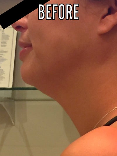 Hành trình biến hóa cổ gà tây nam tính thành cổ mảnh mai nữ tính với Kybella