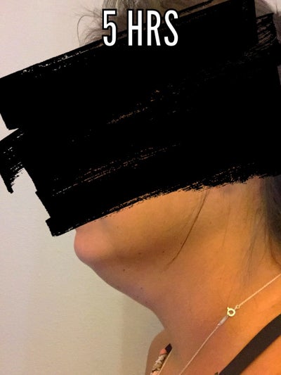Hành trình biến hóa cổ gà tây nam tính thành cổ mảnh mai nữ tính với Kybella