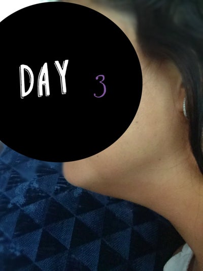 Hành trình biến hóa cổ gà tây nam tính thành cổ mảnh mai nữ tính với Kybella