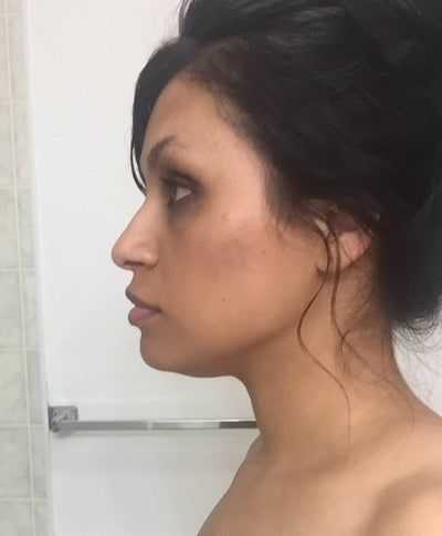 Quá trình tiêm Kybella điêu khắc vùng hàm và loại bỏ túi mỡ thừa lỏng lẻo dưới cằm