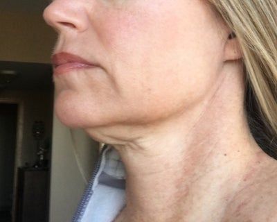 Hạnh phúc của người phụ nữ 52 tuổi đánh tan nọng cằm chỉ sau 1 lần tiêm Kybella