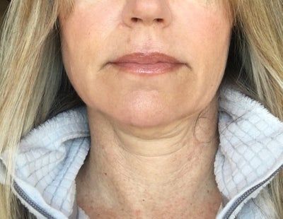 Hạnh phúc của người phụ nữ 52 tuổi đánh tan nọng cằm chỉ sau 1 lần tiêm Kybella