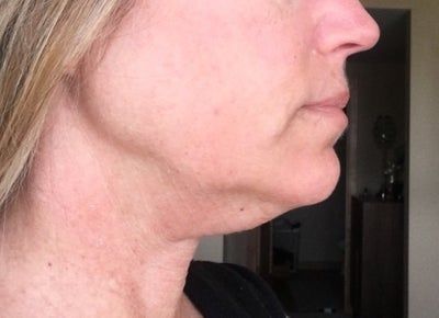 Hạnh phúc của người phụ nữ 52 tuổi đánh tan nọng cằm chỉ sau 1 lần tiêm Kybella