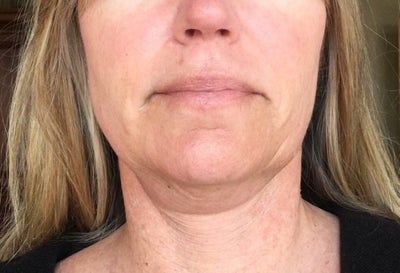 Hạnh phúc của người phụ nữ 52 tuổi đánh tan nọng cằm chỉ sau 1 lần tiêm Kybella