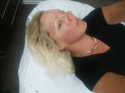 Khuôn mặt thon gọn, da mịn màng như da em bé sau khi làm Ultherapy ở bà mẹ 39 tuổi, 1 con