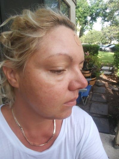 Khuôn mặt thon gọn, da mịn màng như da em bé sau khi làm Ultherapy ở bà mẹ 39 tuổi, 1 con