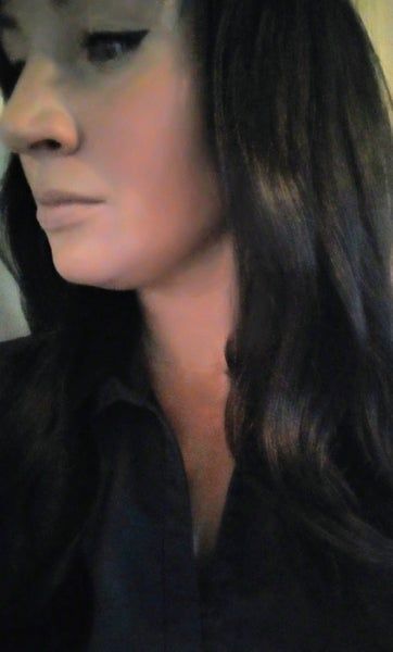 Đường viền quai hàm và khuôn mặt cô gái thay đổi rõ rệt sau khi tiêm 2 lọ Kybella