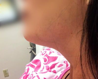 Hành trình biến hóa cổ gà tây nam tính thành cổ mảnh mai nữ tính với Kybella