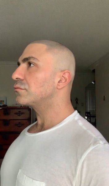 “Ultherapy giúp tôi trẻ ra cả 10 tuổi” – chia sẻ của quý ông 40 tuổi sau 1 lần duy nhất trị liệu Ultherapy