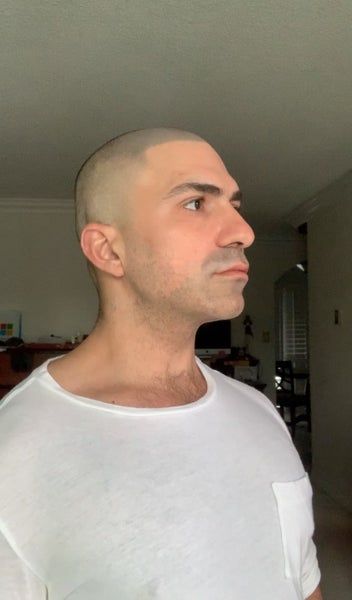 “Ultherapy giúp tôi trẻ ra cả 10 tuổi” – chia sẻ của quý ông 40 tuổi sau 1 lần duy nhất trị liệu Ultherapy