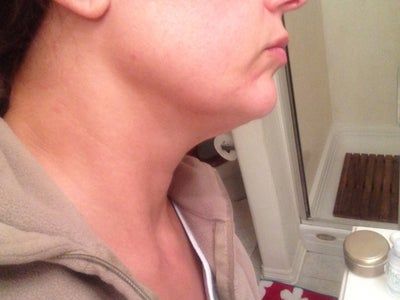 Liệu trình làm Ultherapy cho toàn bộ vùng mặt và vùng cổ trên