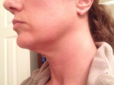 Liệu trình làm Ultherapy cho toàn bộ vùng mặt và vùng cổ trên