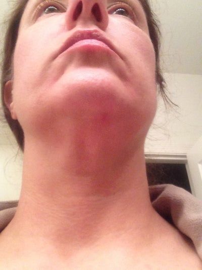 Liệu trình làm Ultherapy cho toàn bộ vùng mặt và vùng cổ trên