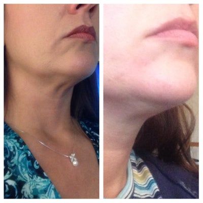 Liệu trình làm Ultherapy cho toàn bộ vùng mặt và vùng cổ trên