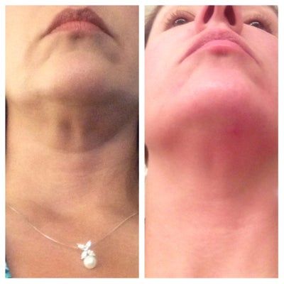 Liệu trình làm Ultherapy cho toàn bộ vùng mặt và vùng cổ trên