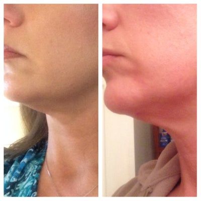 Liệu trình làm Ultherapy cho toàn bộ vùng mặt và vùng cổ trên