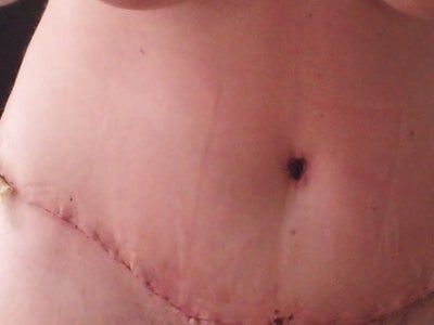 Hành trình căng da bụng mở rộng với đường mổ kéo dài lên hai bên hông và kết quả ngoài mong đợi