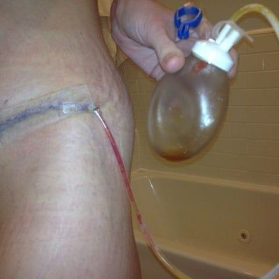 Hành trình loại bỏ khối da thừa nhăn nheo, chảy xệ sau khi giảm kỷ lục 52 kg của mẹ trẻ 2 con