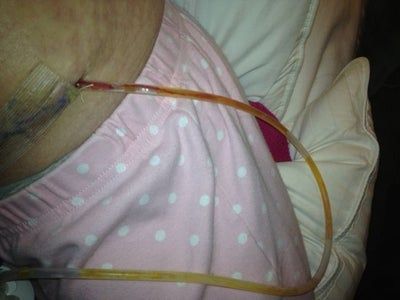 Hành trình loại bỏ khối da thừa nhăn nheo, chảy xệ sau khi giảm kỷ lục 52 kg của mẹ trẻ 2 con